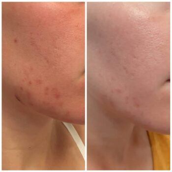 Voor en na 1 microneedling acne littekens verminderen 