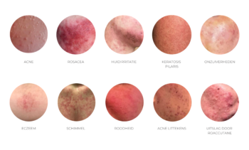 Indicaties voor gebruik Phitex Clear Up Spray - acne, rosacea, schimmel, eczeem, roodheid, irritatie, uitslag door roaccutane, keratosis pilaris