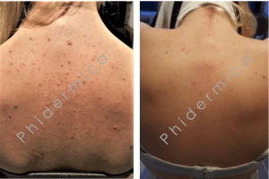 Resultaat rug acne Phitex ClearUp Spray