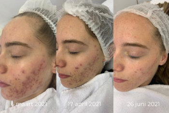 peelings en microneedling acne littekens behandelen