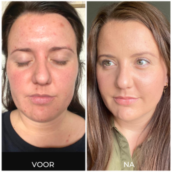 Voor en na acne verminderen met producten (1)