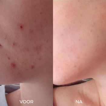 Voor en na foto's acne verminderen met 5 producten