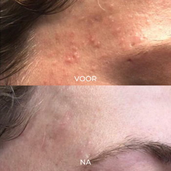 Voor en na acne verminderen 2 behandelingen pagina