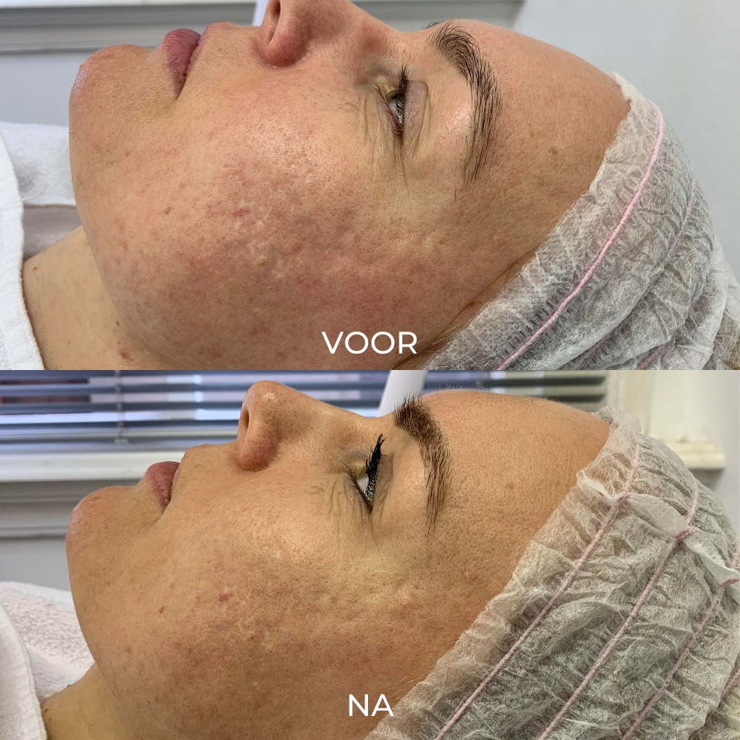 Voor en na resultaten microneedling acne littekens verminderen 2 behandelingen