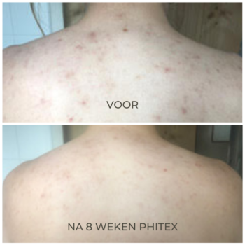 acne littekens verminderen met Phitex ClearUp spray van Phidermica