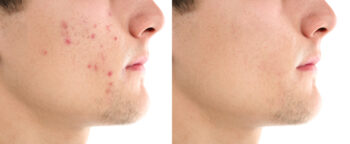 acne tiener voor en na 