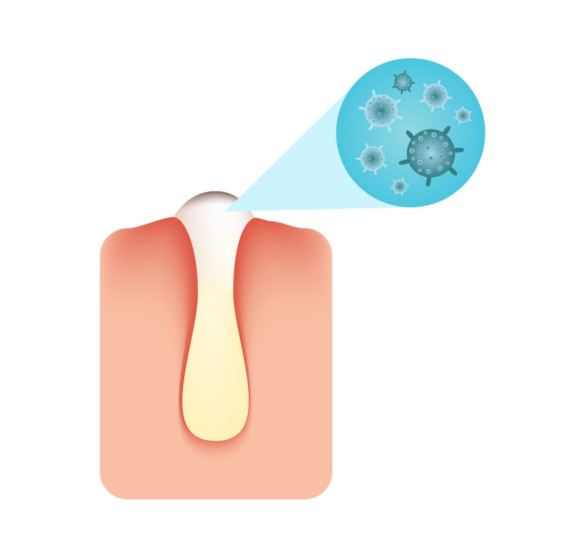 Acne bacterie | anatomy van de huid