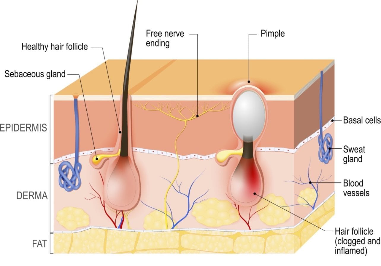 Ontsteking van de huid | huid anatomy acne