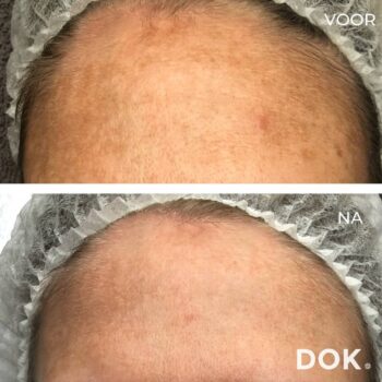 Voor en na foto | huidverbetering | peeling | acnebehandeling | pigment | pigmentatie