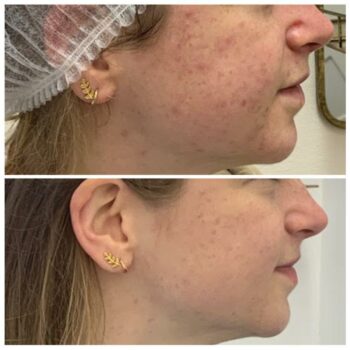behandeling acne verminderen de online kliniek den haag