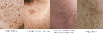 Verschillende soorten pigment melasma, PIHP, ouderdomsvlek, sproeten