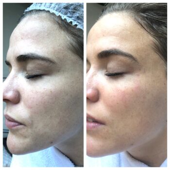 GLOW peeling bij De Online Kliniek in Den Haag - directe boost