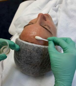 Pigment peeling bij De Online Kliniek in Den Haag: pigmentvlekken verwijderen
