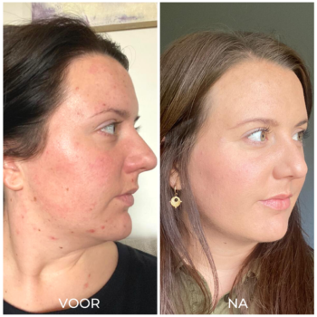 Voor en na acne verminderen met producten (1)