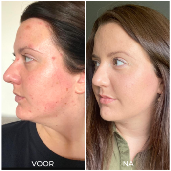 Voor en na acne verminderen met producten 