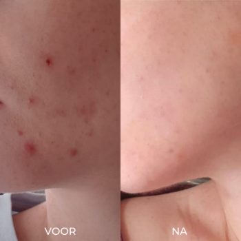 voor na foto met gebruik van acne producten