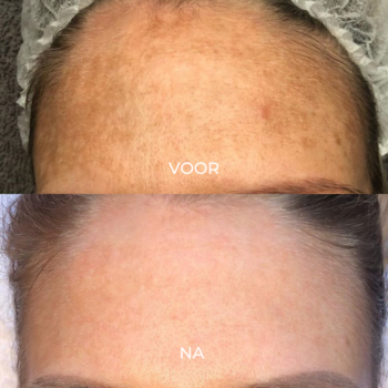 Pigment verminderen met pigment peeling