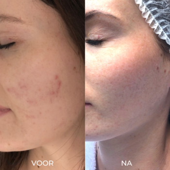 Voor en na foto's acne behandeling De Online Kliniek in Den Haag