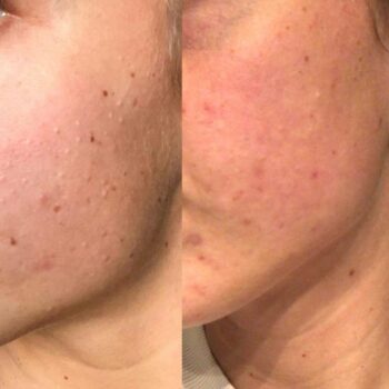 acne behandeling De Online Kliniek voor en na