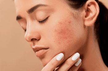acne kin masker acne mascne blog mascne