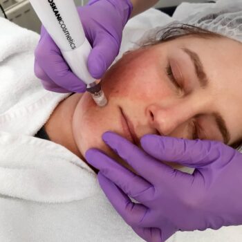 microneedling behandeling den haag met de tkn dermapen van toskani