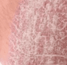 psoriasis huidaandoening rode plekken witte schilfers en jeuk