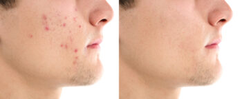 acne tiener voor en na