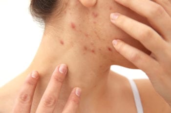 acne verhelpen met de producten van de online kliniek